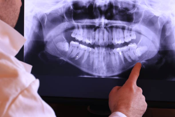 Best Emergency Tooth Extraction in Lusk, WY
